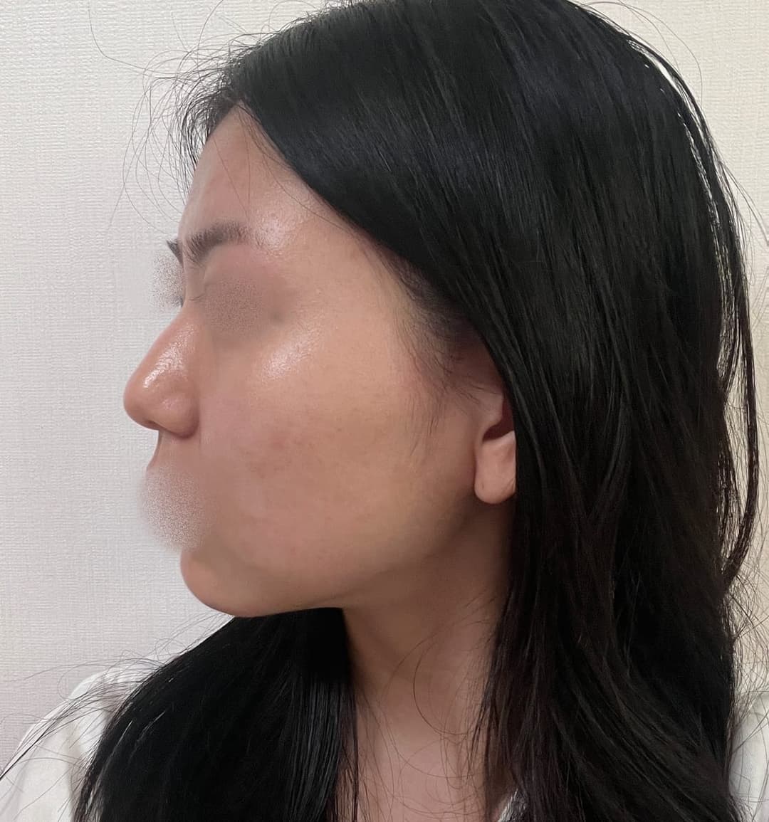 Tip plasty with own cartilage