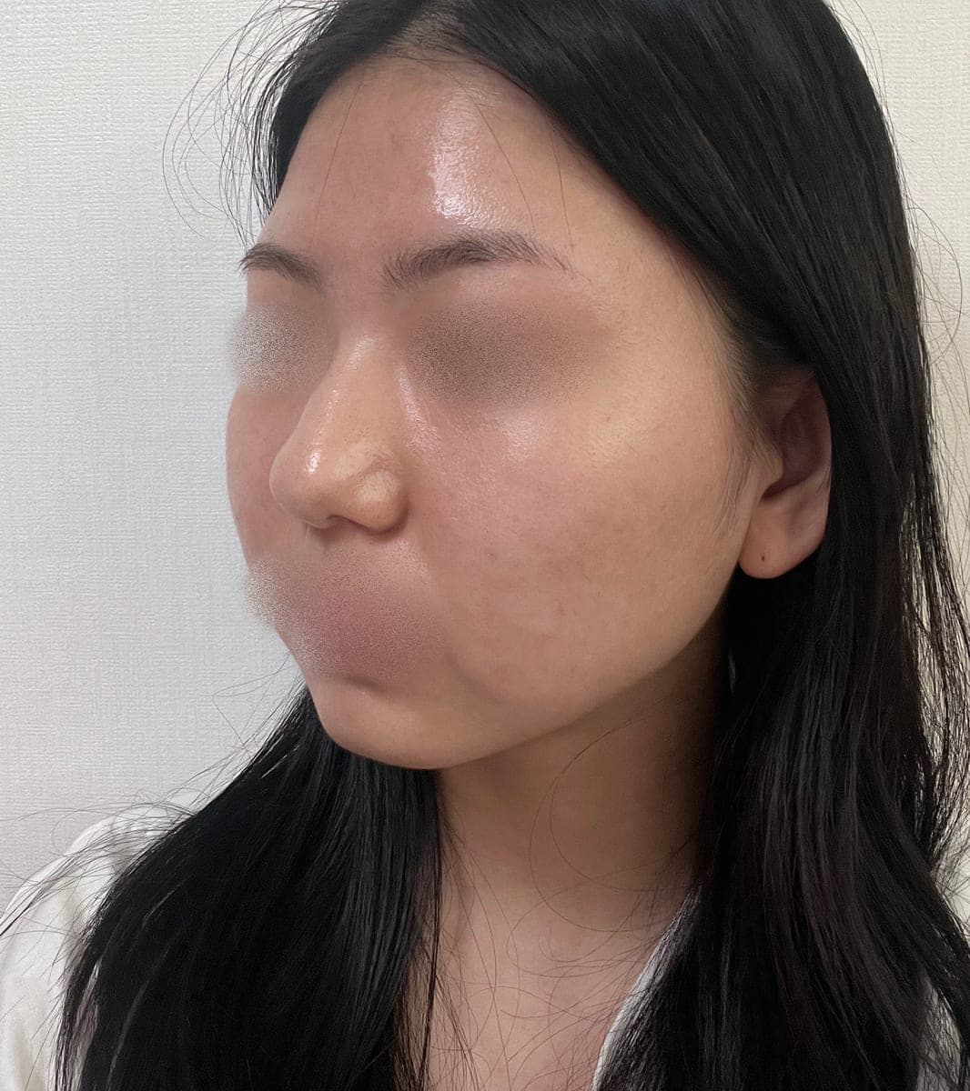 Tip plasty with own cartilage