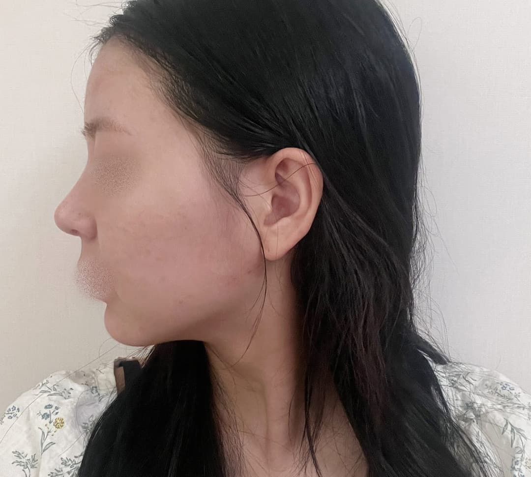 Tip plasty with own cartilage