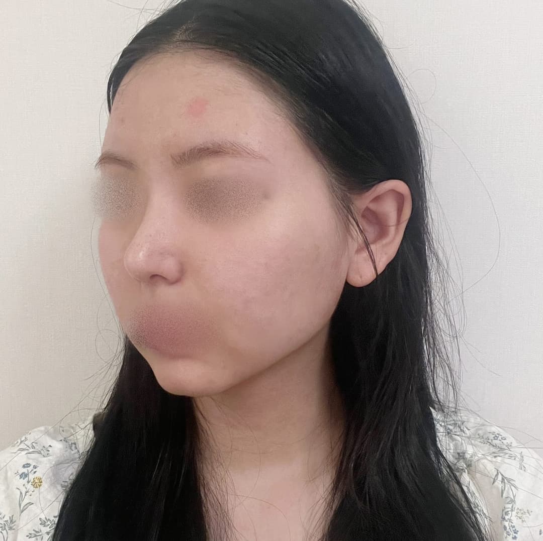 Tip plasty with own cartilage