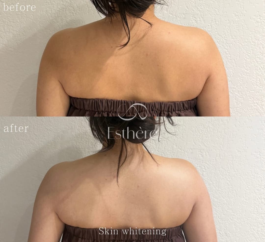 Full-body milk brightening — the nape and back