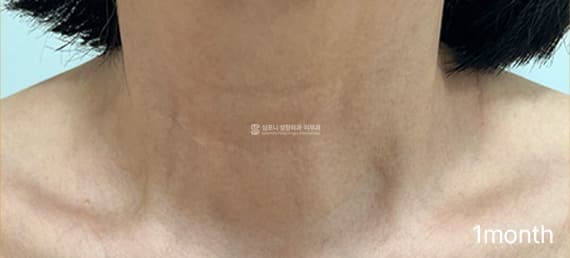 Neck wrinkle filler — After treatment
