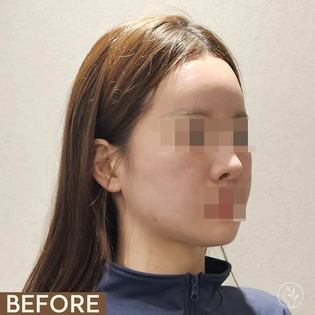 시술 전후 사진