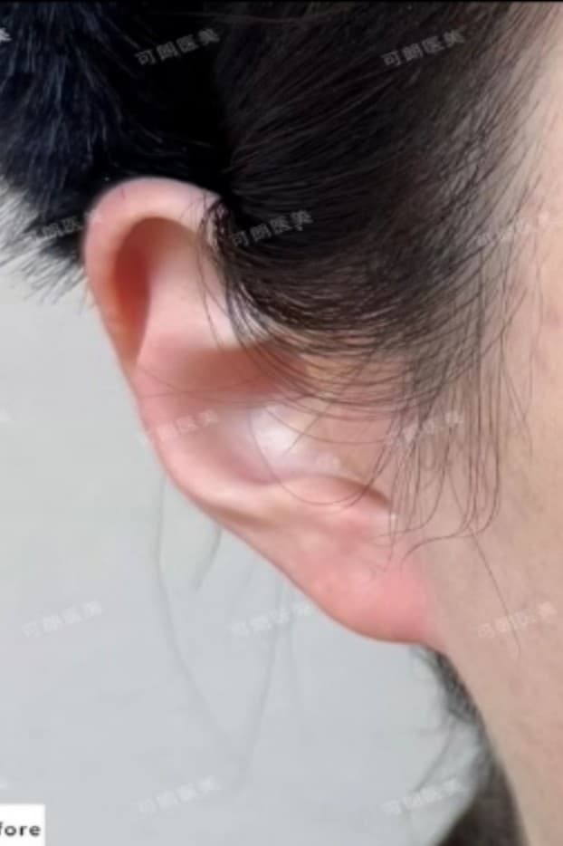 Elf ear filler — Before treatment