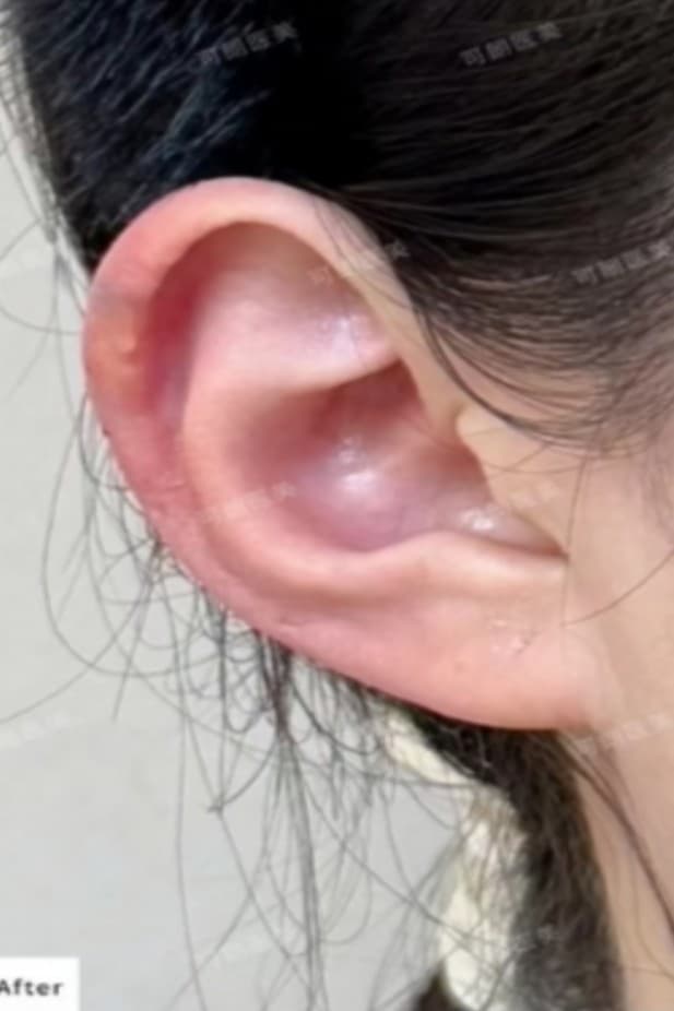 Elf ear filler — After treatment