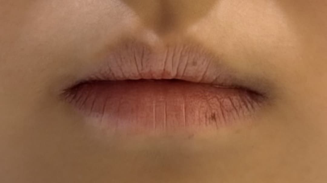 Lip filler — Before treatment