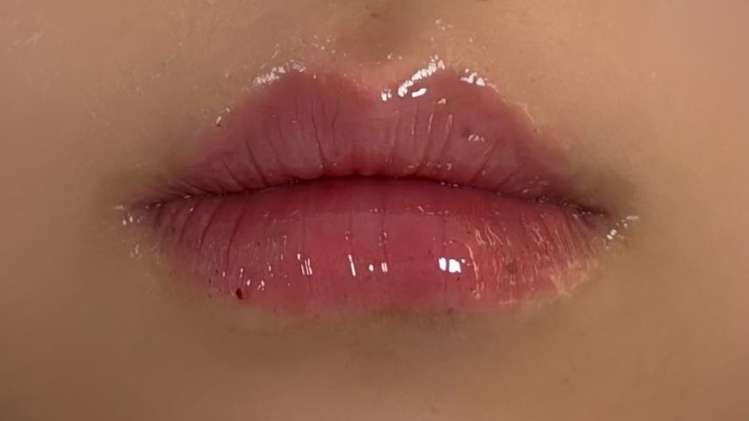 Lip filler — After treatment