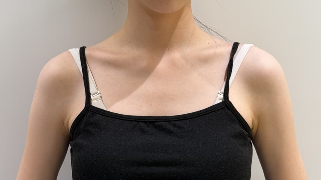 Shoulder filler — Before treatment