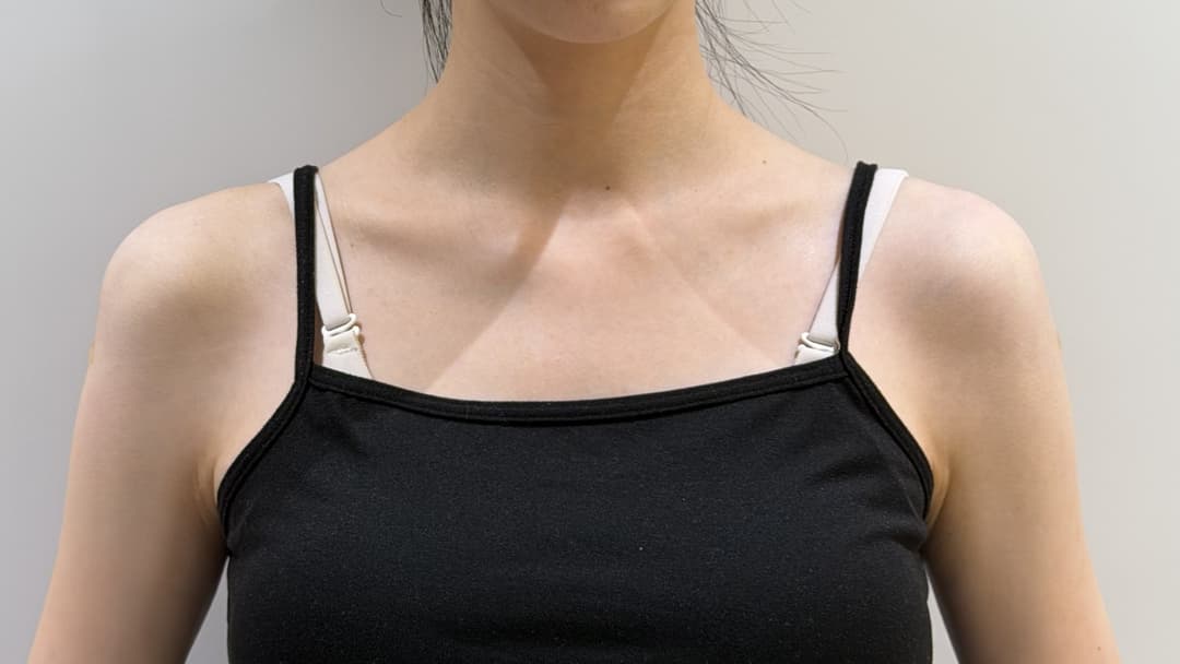 Shoulder filler — After treatment