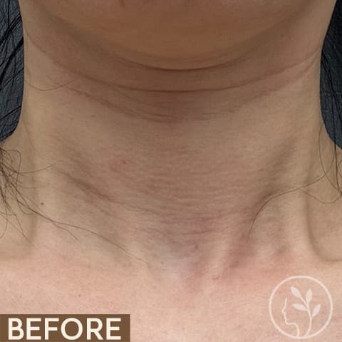 Neck filler — Before treatment