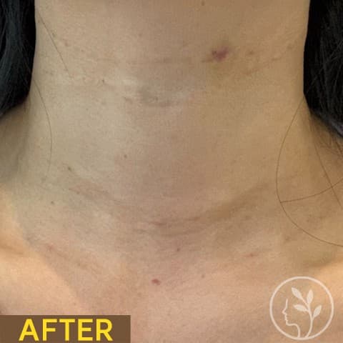 Neck filler — After treatment