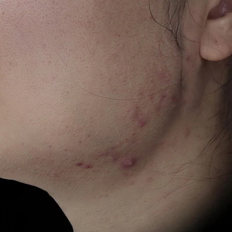 Gold PTT — Before treatment