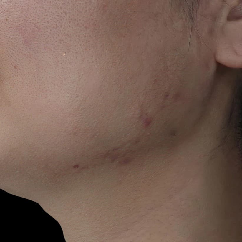 Gold PTT — After treatment