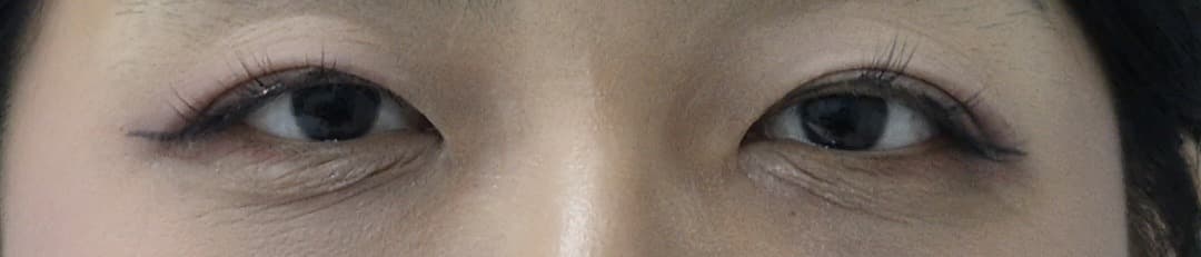 Eyelid surgery — Before treatment