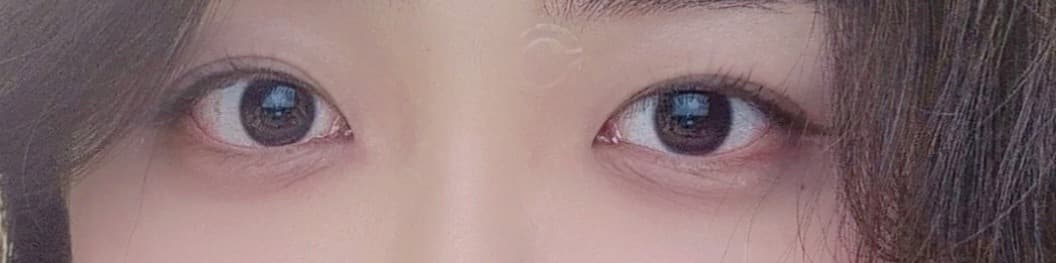 Eyelid surgery — After treatment