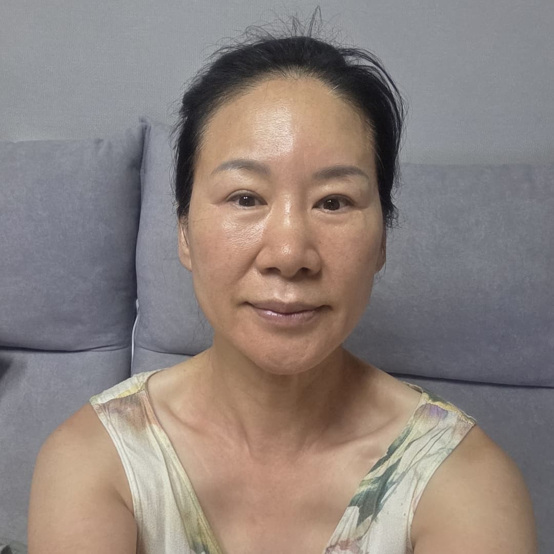 UltraClear — After treatment