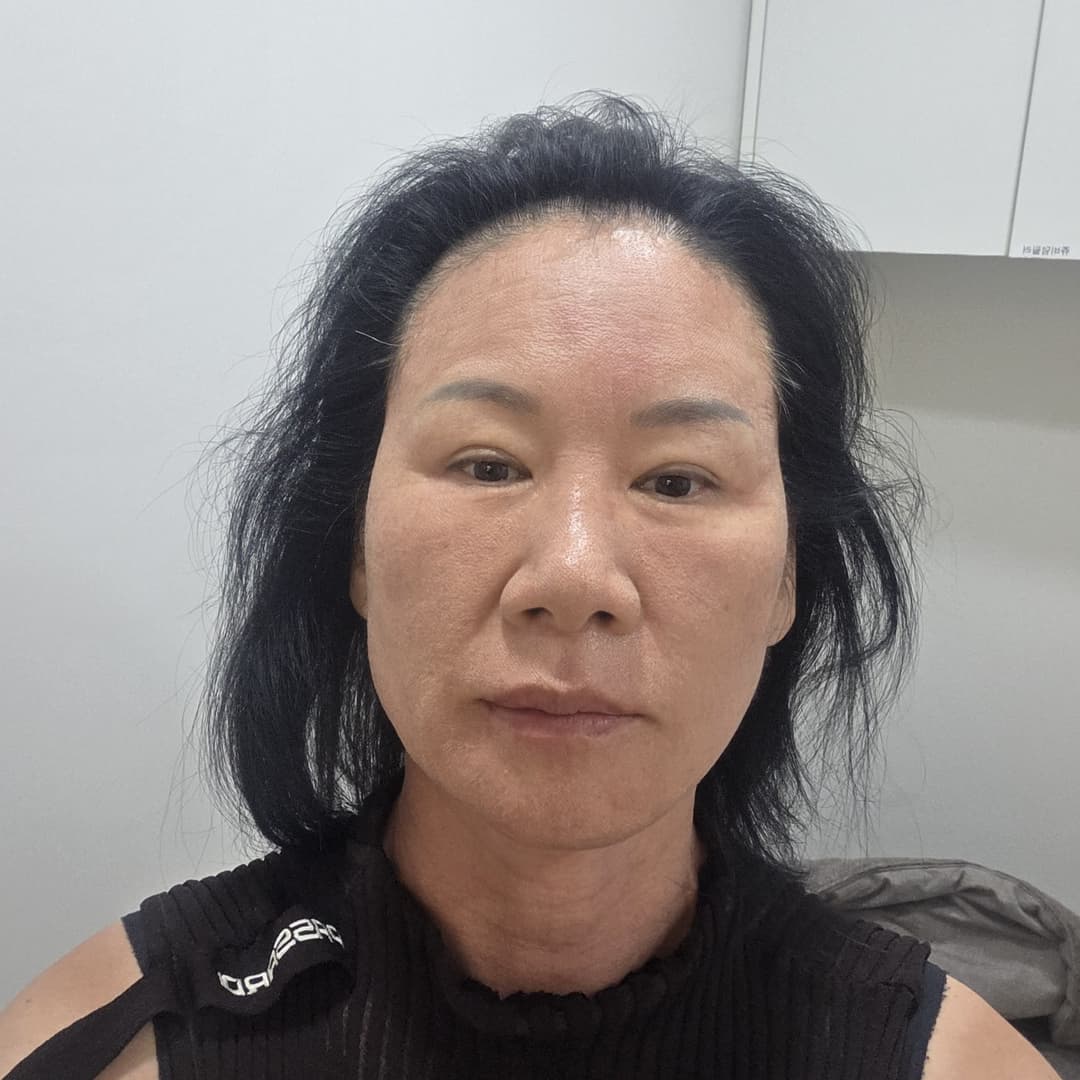 UltraClear — Before treatment
