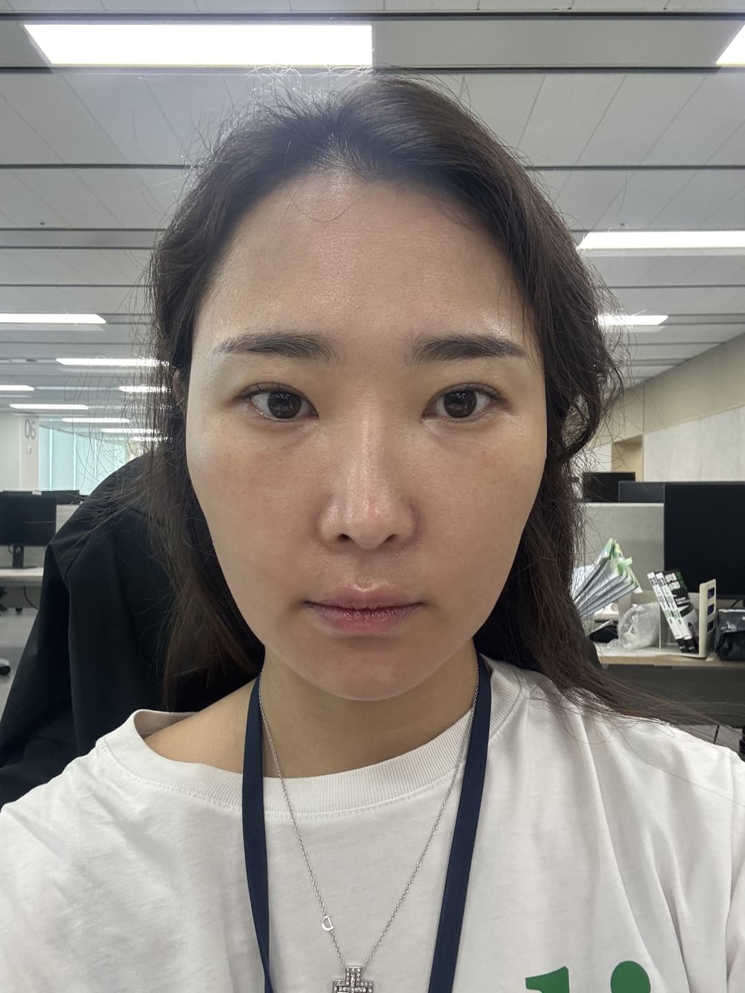 UltraClear — Before treatment