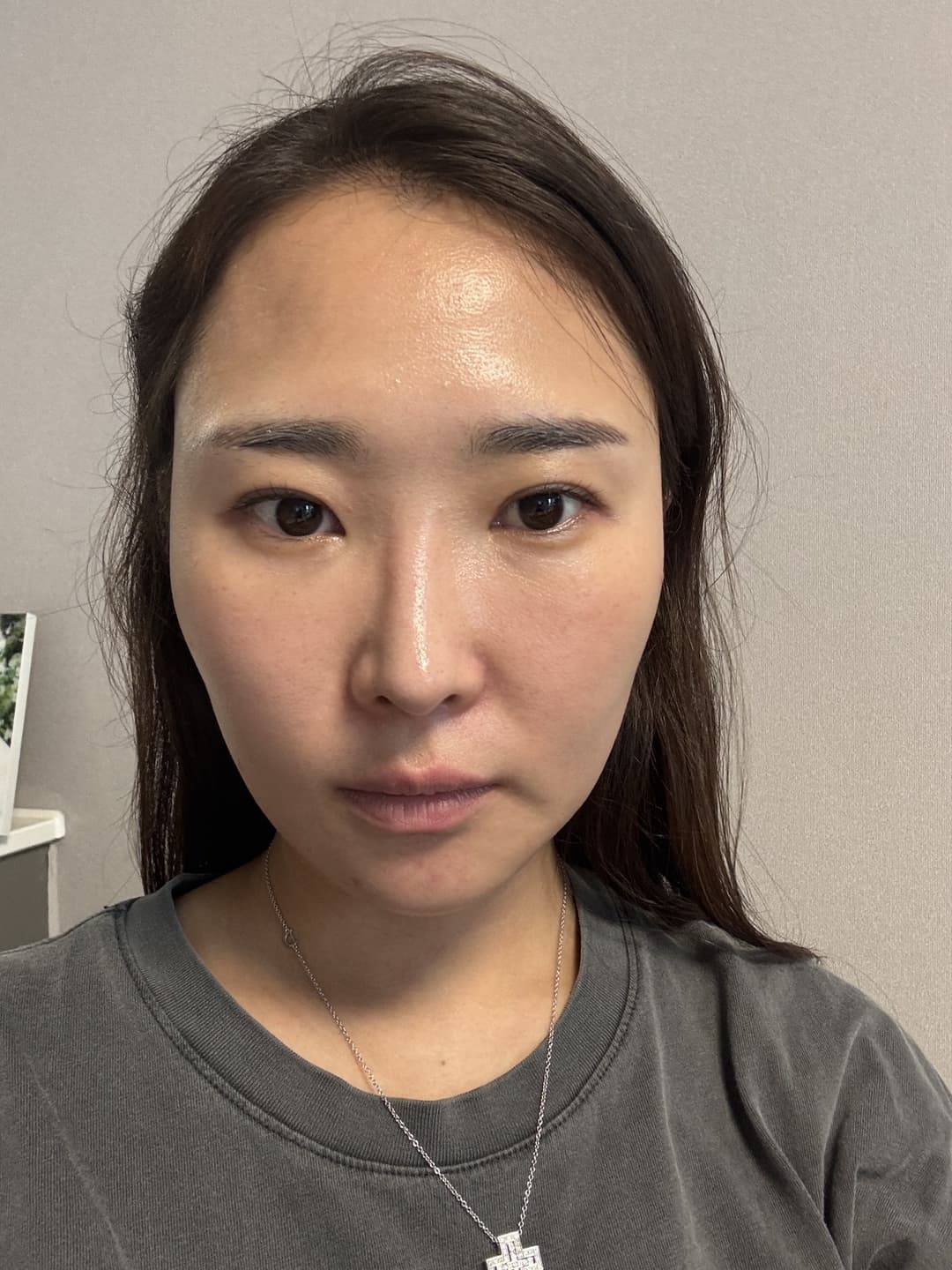 UltraClear — After treatment