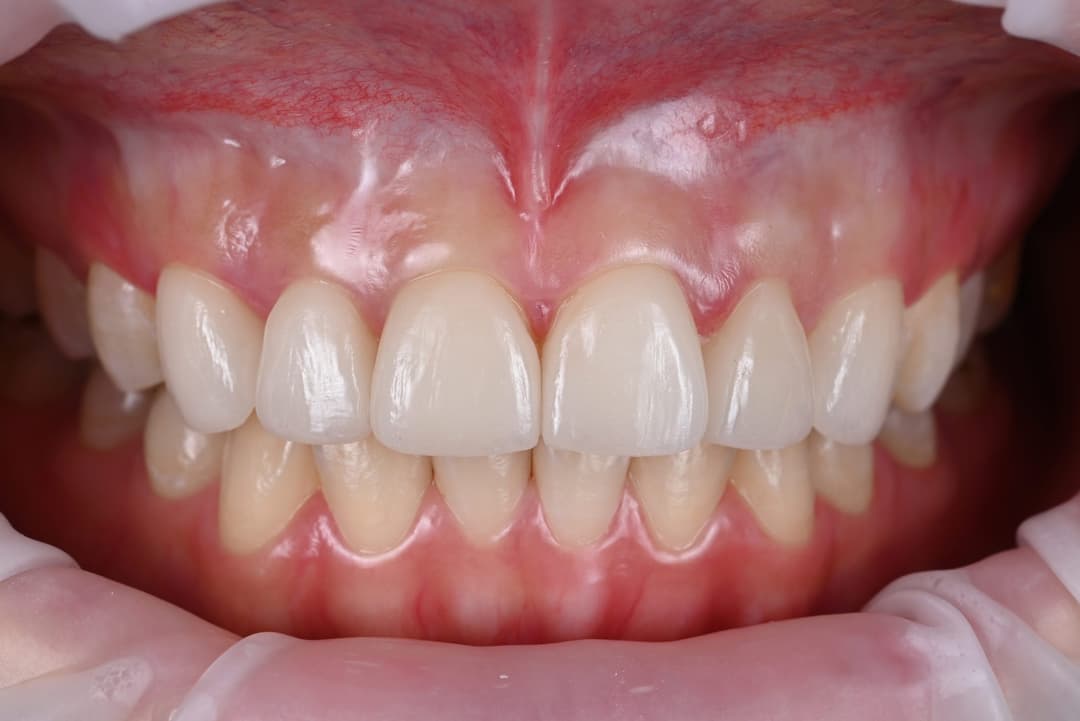 Dental laminate veneers — After treatment