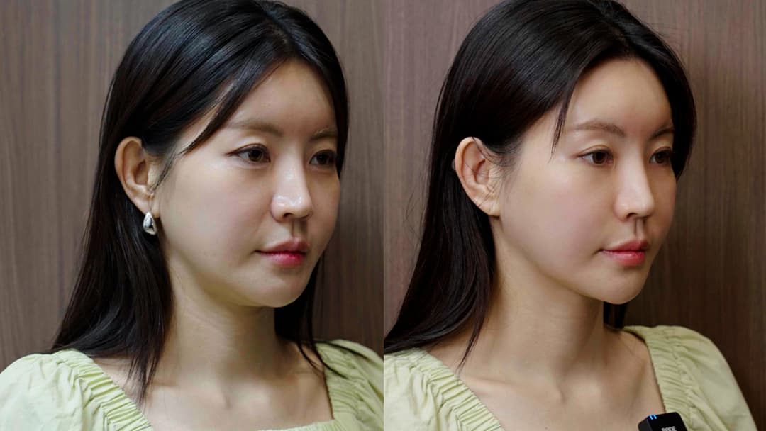 Alltight — Before and after